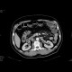 Sclerosing mesenteritis: CT - Computed tomography